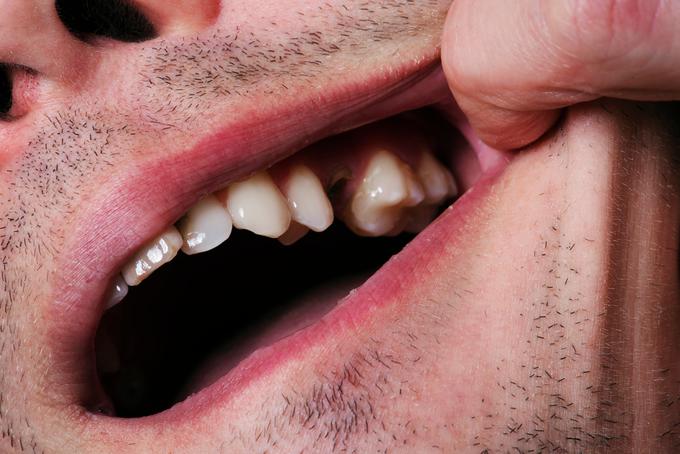 izguba zoba, zobje, implantant, zobni vsadek | Foto: Shutterstock