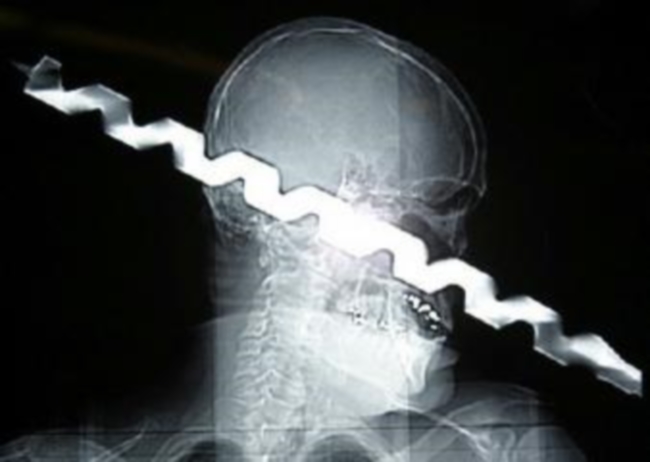 Ameriški gradbenik Ron Hunt je leta 2003 padel z lestve z obrazom naprej, njegov padec pa je ublažil velikanski sveder delujočega vrtalnega stroja, na katerega se je Hunt nasadil točno z desnim očesom. Sveder se je prebil skozi Ronove možgane in izstopil na zadnjem delu lobanje. To je resnična fotografija rentgenskega pregleda Huntove glave.  | Foto: 