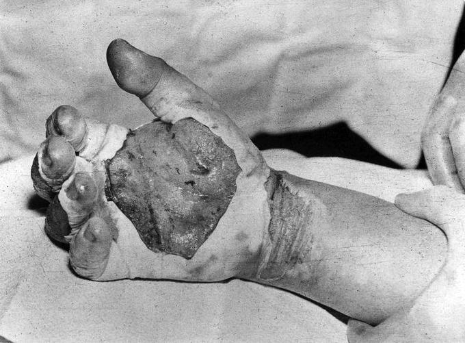 Roka Harryja Daghliana nekaj dni po nesreči.  | Foto: Arhiv Los Alamos