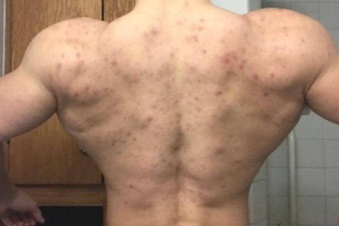 Akne se pri uporabnikih steroidov najpogosteje pojavijo na hrbtu ali pa na ramenih in trapezih - delih telesa z največ androgenimi receptorji, ki se tudi najhitreje in najbolj opazno odzovejo na začetek dodajanja steroidov.  | Foto: Reddit/AstinNoram