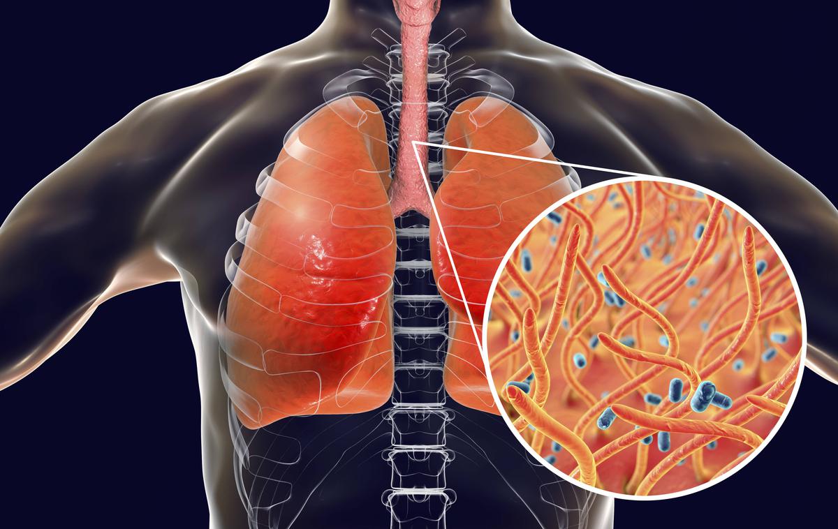 oslovski kašelj | Oslovski kašelj je bolezen dihal, ki jo povzroča bakterija Bordetella pertussis, ki se nahaja v ustih, nosu in žrelu. Otroci, ki zbolijo za oslovskim kašljem, imajo lahko epizode kašlja, ki trajajo od štiri do osem tednov. | Foto Guliverimage