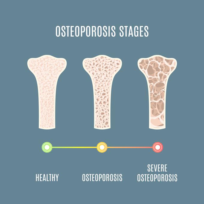 osteoporoza-zdravljenje-medicofit | Foto: 