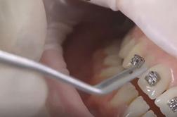 Čakanje na ortodonta tudi do štiri leta #video