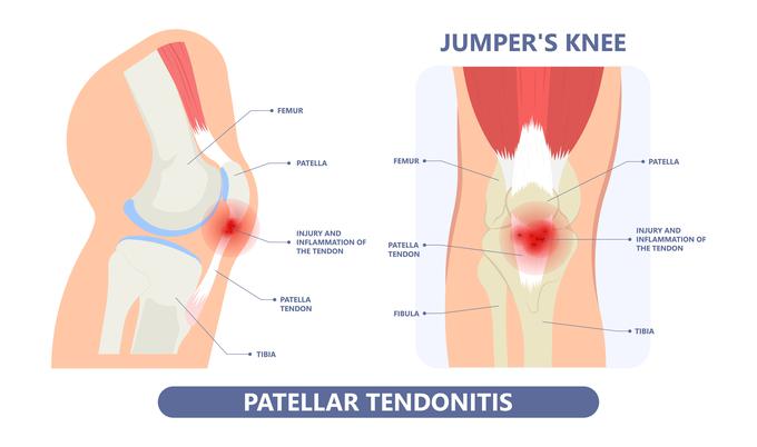 Skakalno koleno - patelarna tendinopatija - slika 1 | Foto: Medicofit