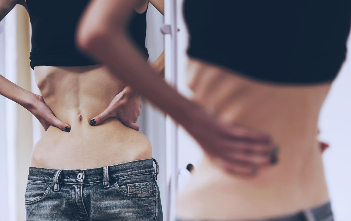 Anoreksija | Anoreksija je motnja hranjenja, za katero lahko zbolijo ljudje vseh starosti in obeh spolov, čeprav so k njej malo bolj nagnjena mlada dekleta in ženske. | Foto Getty Images