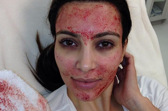 Kim Kardashian vampirski lifting | Foto Instagram