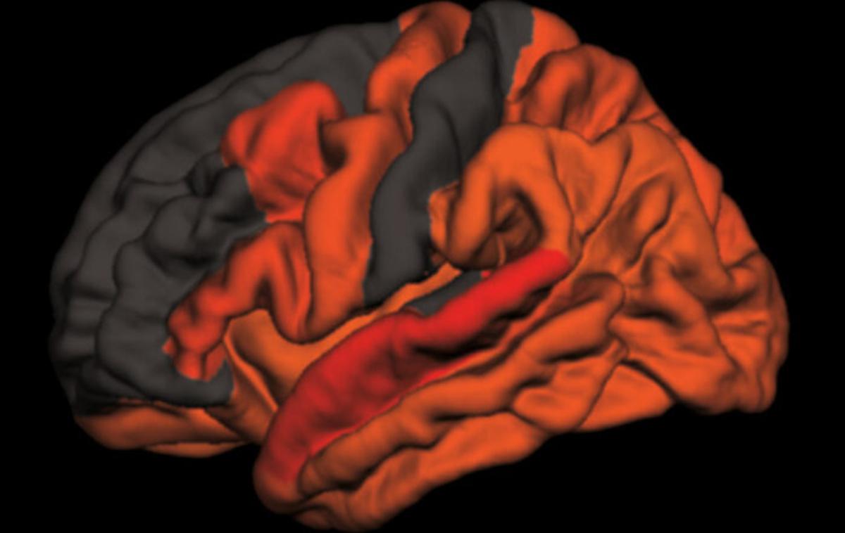 možgani, Alzheimerjeva bolezen | Računalniško generiran "termometer", ki ponazarja, kje v možganih je povezava med pomanjkanjem kakovostnega spanja in povečanih količinah strupenega možganskega proteina tau največja. | Foto Brendan Lucey