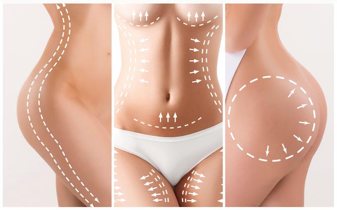 Lepotna operacija, liposukcija | Foto: Thinkstock