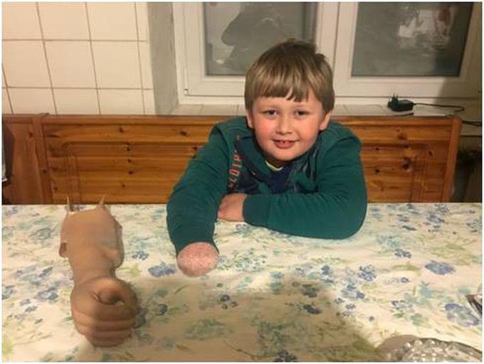 Jakob je pri štirih letih zaradi nesreče ostal brez spodnjega dela svoje desne roke. | Foto: 