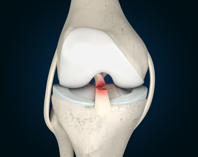 zdravljenje-po-artroskopiji-kolena-medicofit | Foto: Medicofit
