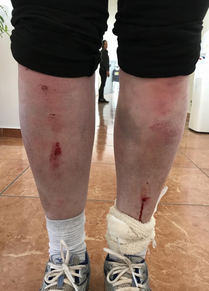 Poškodbe, ki so preprečile Brigiti Jarc, da bi lahko nadaljevala premagovanje zahtevnih poligonov. | Foto: 