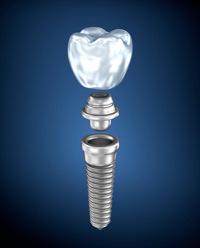 zobje implantant zobar zdravje | Foto: Thinkstock