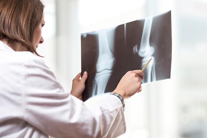 zdravnik rentgen koleno | KPK je v prijavi zoper Univerzitetni klinični center (UKC) Ljubljana zaradi domnevno prirejenega javnega naročila rentgenskih in CT-naprav ugotovila sum kaznivega dejanja in zadevo predala policiji.  | Foto Shutterstock
