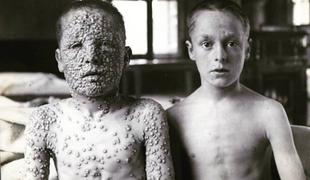 Fotografija grozljive bolezni, ki so jo kazali nasprotnikom cepljenja