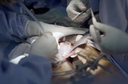 Umrl moški s prvo presajeno gensko spremenjeno ledvico prašiča