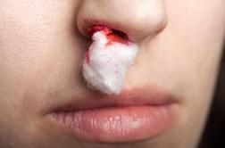 Kako pravilno ustaviti krvavitev iz nosu