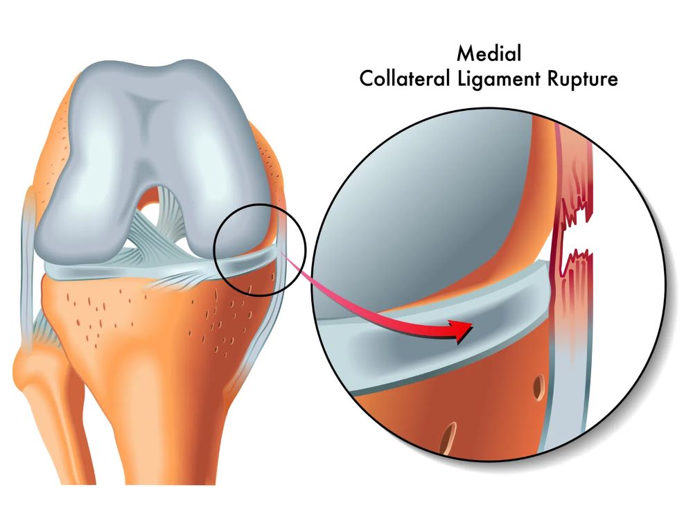 Medicofit, danos nos ligamentos do joelho | Foto: Shutterstock