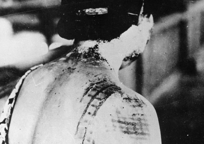 Poškodbe oziroma opekline ene od Japonk, ki je preživela eksplozijo atomske bombe. | Foto: Narodni arhivi ZDA