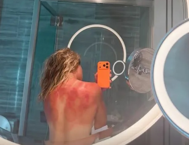 Renata Zarazua je spoznala, da z avstralskim soncem ni šale. | Foto: Instagram