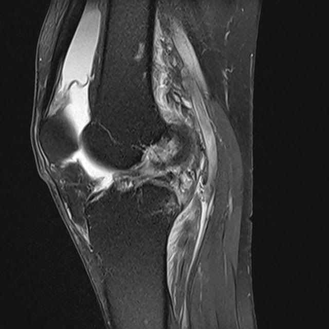 križne vezi | Foto: UKC Ljubljana