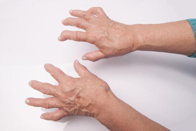 Simptomi osteoartroze | Foto: Medicofit