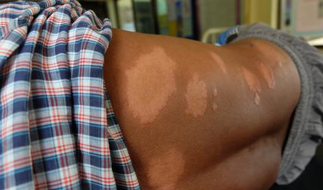 Na Hrvaškem po več desetletjih potrdili primer gobavosti