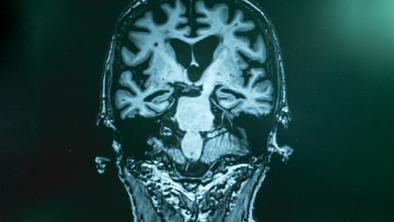 Novo upanje za bolnike z Alzheimerjevo boleznijo?