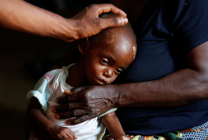Podhranjena 19-mesečna Kaba Bitika Marie med zdravniško oskrbo. | Foto: Reuters