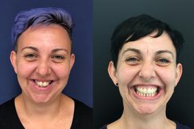 Nevidni zobni aparat Invisalign sedaj 30 % ceneje!
