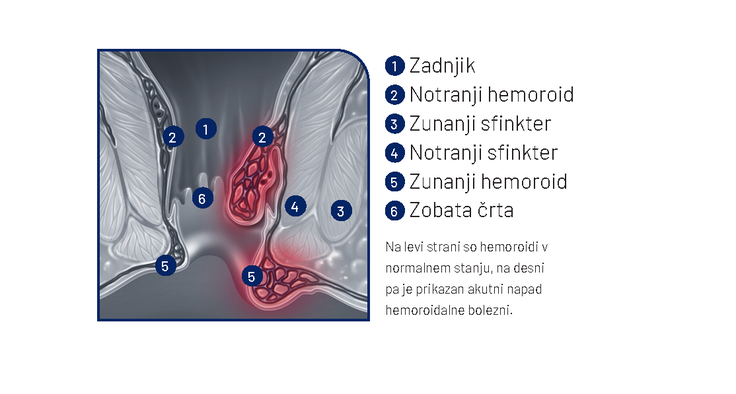 Detralex, hemoroidi | Foto: arhiv naročnika