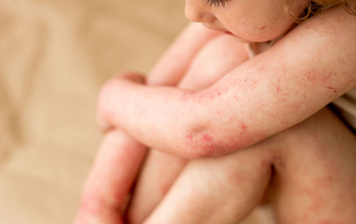 Atopijski dermatitis | Otrok z izrazitimi simptomi atopijskega dermatitisa – boleznijo, ki močno vpliva na kakovost življenja najmlajših in njihovih družin. | Foto INES IMAGES