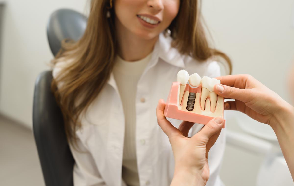 implatant, zobni vsadek, zobje, zobozdravnik | Foto Shutterstock