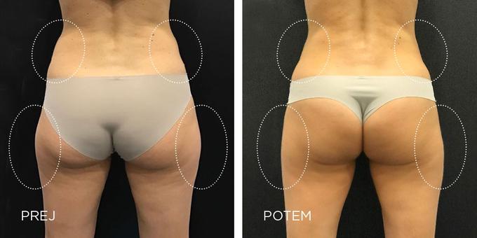 CoolSculpting poseg | Foto: 