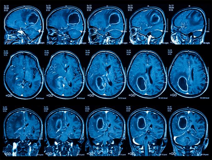 Posnetek magnetne rezonance, na katerem se vidi možganski tumor. Rib ecebrice so pomagale tudi pri odkrivanju spoznanj o tem bolezenskem stanju. | Foto: Thinkstock
