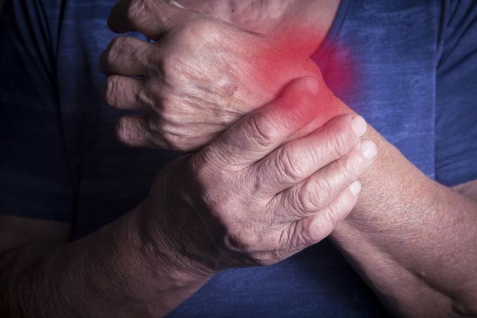 Zapestje revmatoidni artritis | Foto: Medicofit
