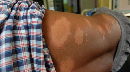 Na Hrvaškem po več desetletjih potrdili primer gobavosti