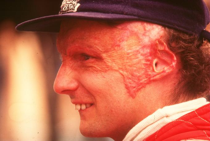 Takole je bil videti obraz Nikija Laude po nesreči v Nürburgringu. | Foto: Getty Images