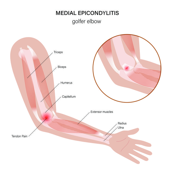 medialni-epikondilitis-zdravljenje-medicofit | Foto: Medicofit