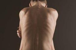 Thinspiration: nevarno spodbujanje k hujšanju in anoreksiji