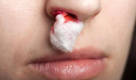 Kako pravilno ustaviti krvavitev iz nosu