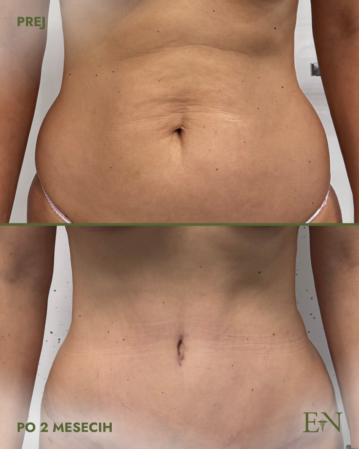 ernest novak abdominoplastika | Foto: Dr. Ernest Novak