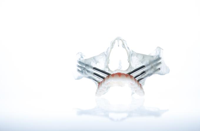 Za vsadke Zygoma zadošča minimalna količina kosti. Zaradi te metode so zdaj prav vsi primerni za vstavitev zobnih vsadkov. | Foto: ORTOIMPLANT DENTAL SPA