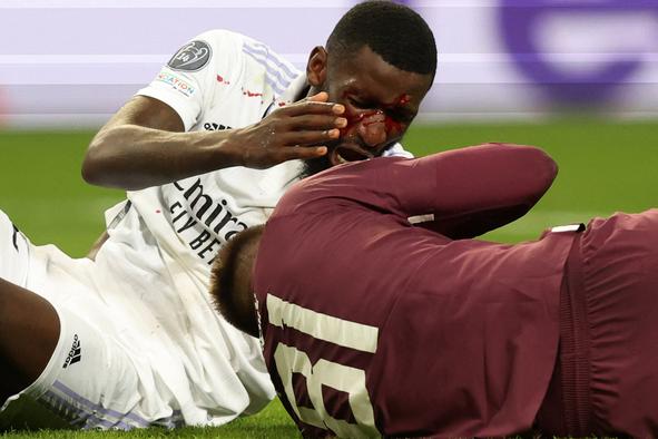 Rešil Real Madrid in jo odnesel z 20 šivi