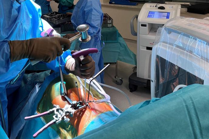 operacija, XLIF, kirurgija | Uvajanje sonde v medvretenčni prostor med operacijo po metodi XLIF v ljubljanskem UKC | Foto Lovro Suhodolčan