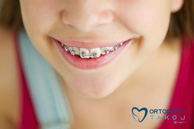 Čezmejni zobni aparat je otrokova pravica iz obveznega zdravstvenega zavarovanja. Omogoča mu takojšnje zdravljenje anomalij zobnih položajev in ugriza ter povračilo stroškov za zobni aparat od ZZZS. Pravna podlaga je 44. c člen ZZVZZ in 34. člen POZZ.  | Foto: ORTODONT TAKOJ®
