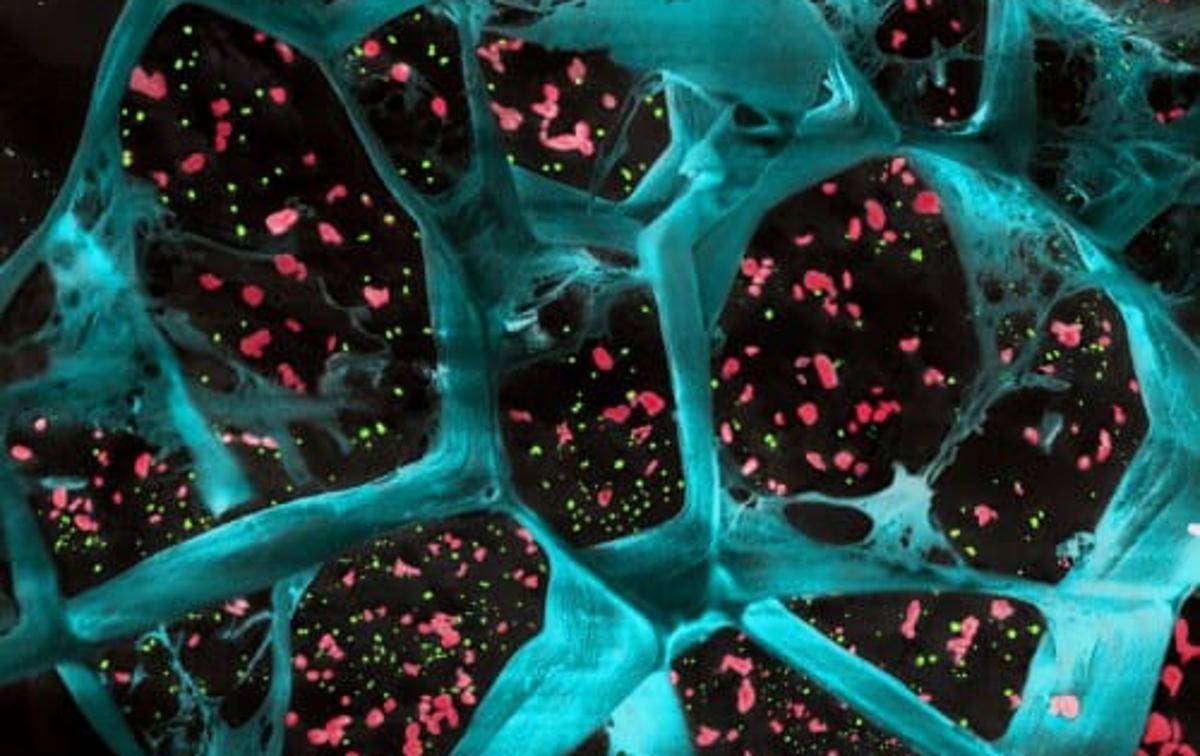 gel, rak | Mikroskopska slika hidrogela (modra barva) z učinkovinama (rdeča in zelena) za preprečevanje (ali vsaj bistveno upočasnjevanje) ponovnega razvoja rakastih celic | Foto University of Wisconsin–Madison