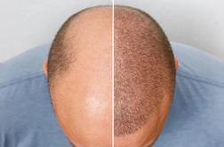 Metoda, ki obnovi lase v 21 dneh in je primerna za vsakogar