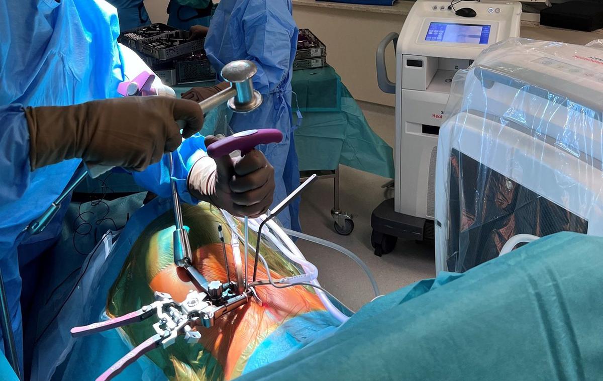 operacija, XLIF, kirurgija | Uvajanje sonde v medvretenčni prostor med operacijo po metodi XLIF v ljubljanskem UKC | Foto Lovro Suhodolčan