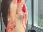 THUMB - Rui Oliveira, padec