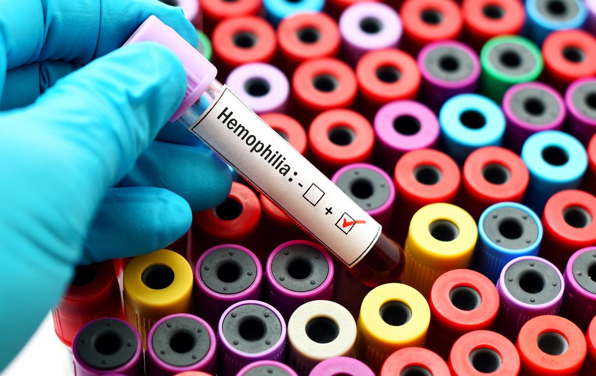 hemofilija | Danes je svetovni dan hemofilije, redke genske bolezni, ki se kaže v obliki motenj v strjevanju krvi. S kakšnimi težavami se soočajo slovenski hemofiliki? | Foto Getty Images